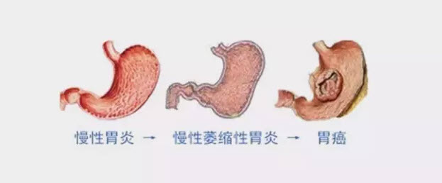 胃癌的演变过程