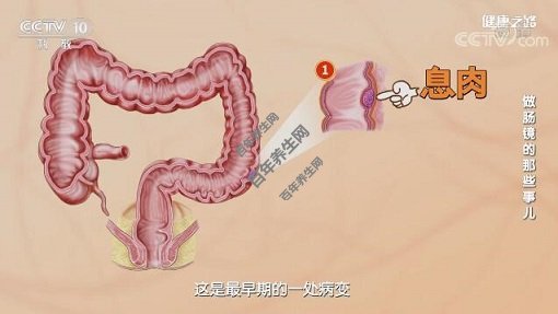 肠癌的发展过程-息肉