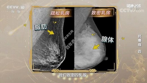 X光片下的疏松乳房VS致密乳房