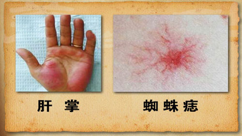 两张图都是疾病隐患在手掌上的表现