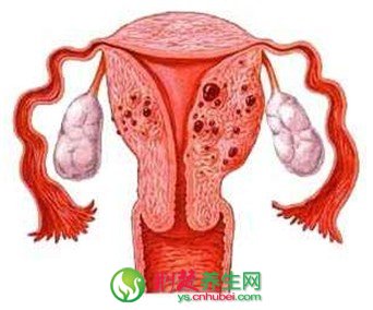 子宫内膜异位症的症状与预防