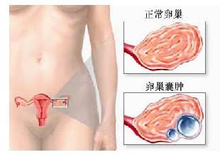 女性得了卵巢囊肿会影响排卵吗