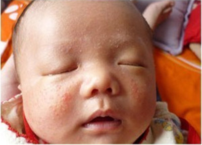 什么是婴儿湿疹 婴儿湿疹临床表现介绍