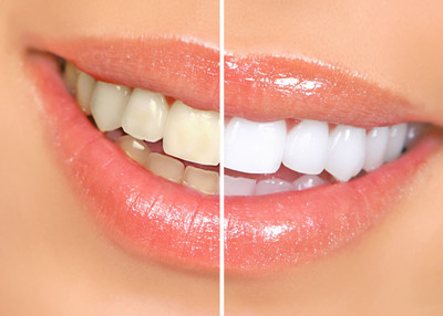 四环素牙能洗白牙齿吗