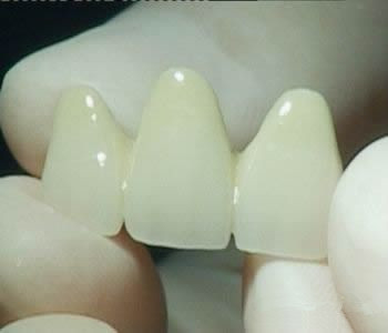 烤瓷牙治疗四环素牙的优势