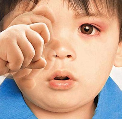 红眼病的预防常识及注意事项