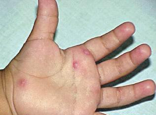 手足口病初期症状图片及治疗法