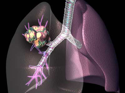 肺癌是气出来的病 肺癌的治疗方法(2)