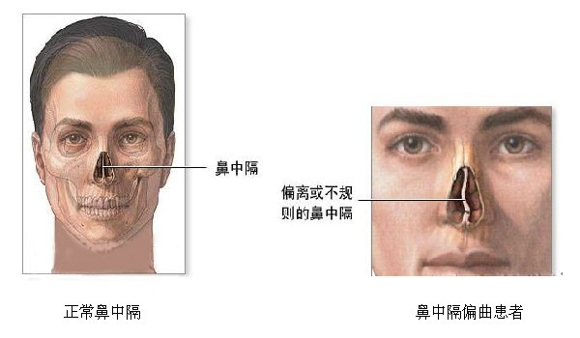 男子鼻中隔弯曲术后致容貌尽毁 了解鼻中隔弯曲术的病因