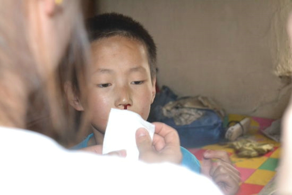宁波1岁幼童便秘就流鼻血 流鼻血该如何正确止血