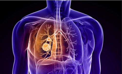 肺癌的早我症状有哪些 肺癌会传染吗(2)