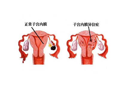 揭秘子宫内膜异位的真相 引发不孕的病机(2)