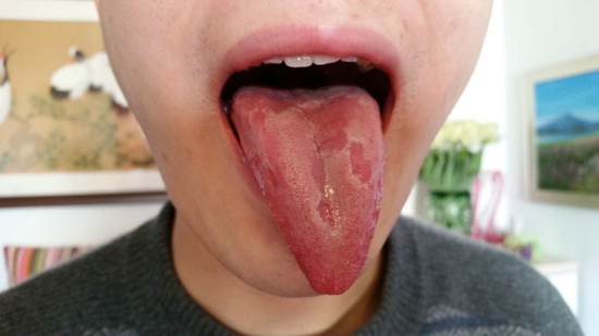 舌头被开水烫了怎么办 烫伤后吃什么好