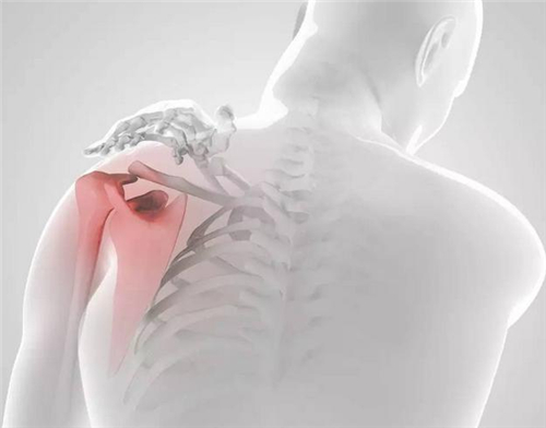 肩周炎怎么办 预防肩周炎你知道怎么做吗
