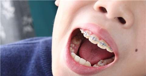 儿童怎么矫正牙齿