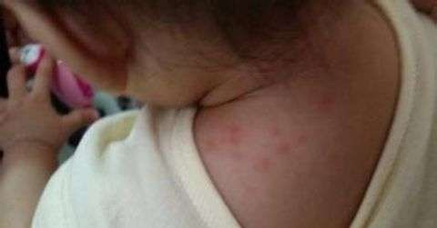 宝宝起湿疹的原因