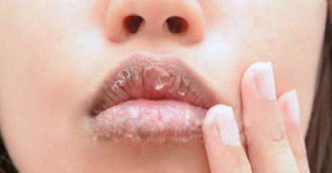 冬季嘴唇干裂起皮的原因