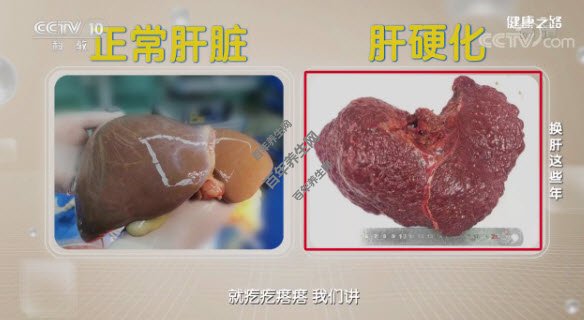 正常的肝脏vs肝硬化