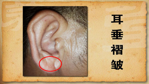 90%的冠心病患者的耳垂都会出现这种斜纹褶皱