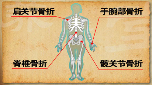  髋关节、腕部、肩关节、脊椎，是骨质疏松容易引发的四大骨折部位。