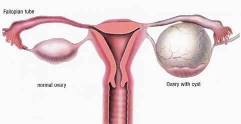 卵巢囊肿手术后的调理方法