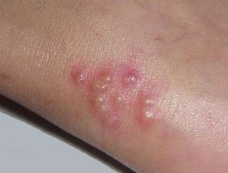 水痘和手足口病有哪些区别