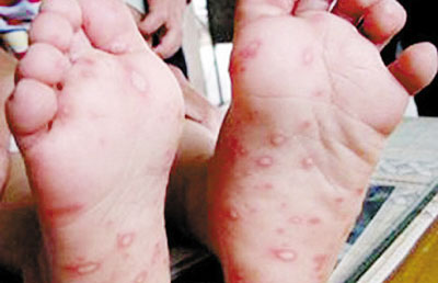 水痘与手足口病的区别有哪些