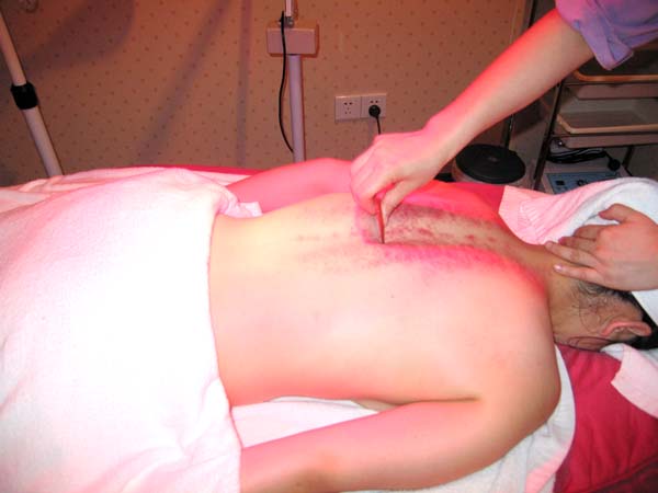 腰椎间盘突出症急性期的使用刮痧治疗