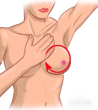 乳房肿块要重视 了解乳腺癌早起症状