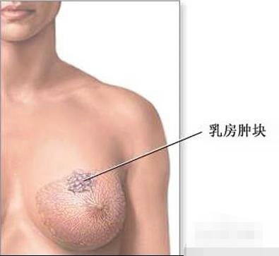 乳房肿块要重视 了解乳腺癌早起症状