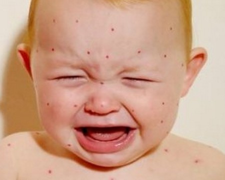 湿疹是怎么引起的 湿疹的治疗方法