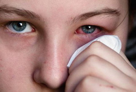 红眼病是结膜炎吗 结膜炎是怎么回事