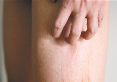 缓解冬季皮肤瘙痒的方法 皮肤瘙痒与脏器疾病(2)