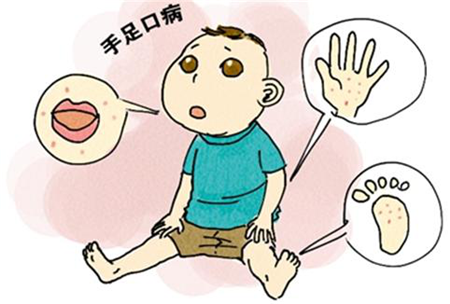 手足口病疱疹怎么治 如何区分水痘和手足口病