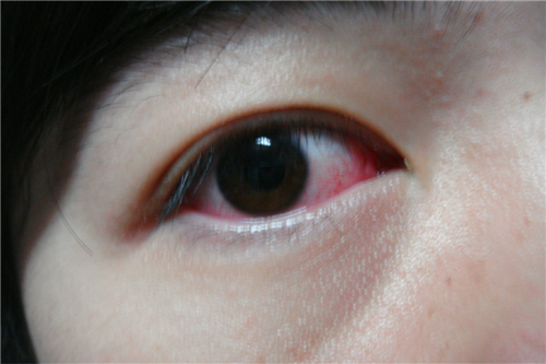 红眼病怎么传染 红眼病的注意事项