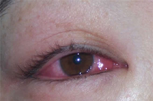 红眼病怎么传染 红眼病的注意事项