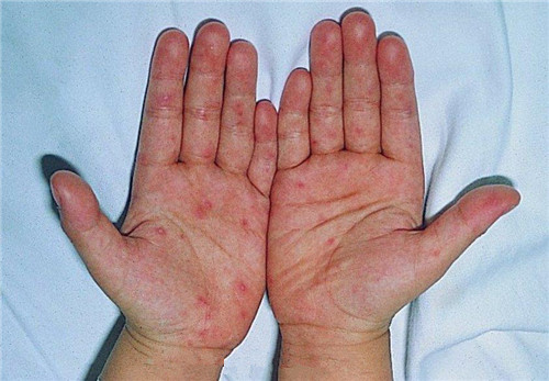 手足口病初期症状 手足口病治疗