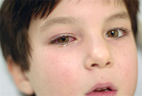 如何预防红眼病 红眼病的日常饮食