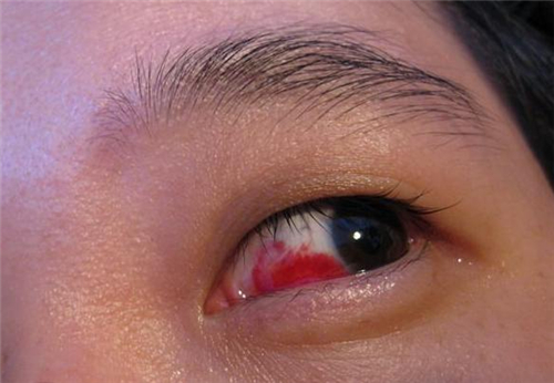 红眼病的传染方式 治疗红眼病的偏方