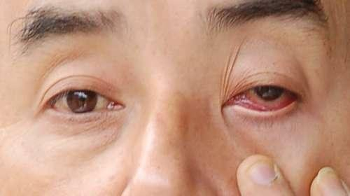 红眼病的传染方式 治疗红眼病的偏方
