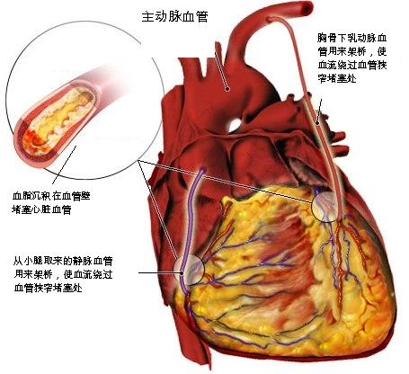 心脏供血不足的症状盘点 如何防控制心脏供血不足