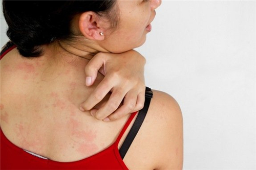 皮肤瘙痒是怎么回事 皮肤瘙痒预示着疾病