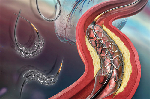 心血管支架是什么 心脏支架手术后注意事项