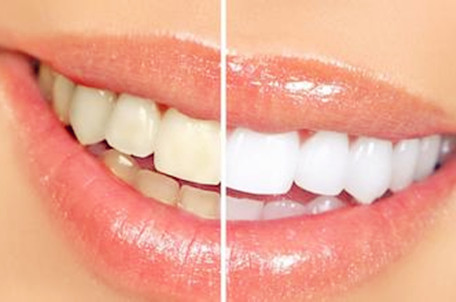牙齿黄是什么原因 6方法恢复美白牙齿