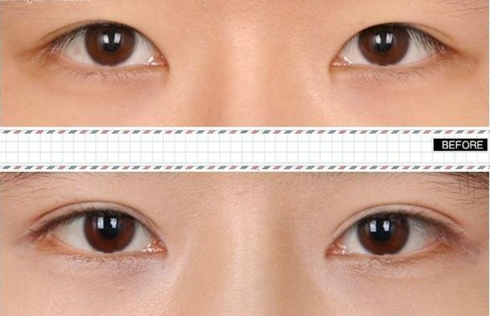 割双眼皮的最佳年龄 割双眼皮适合人群