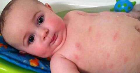 婴儿出疹后皮肤很红正常吗